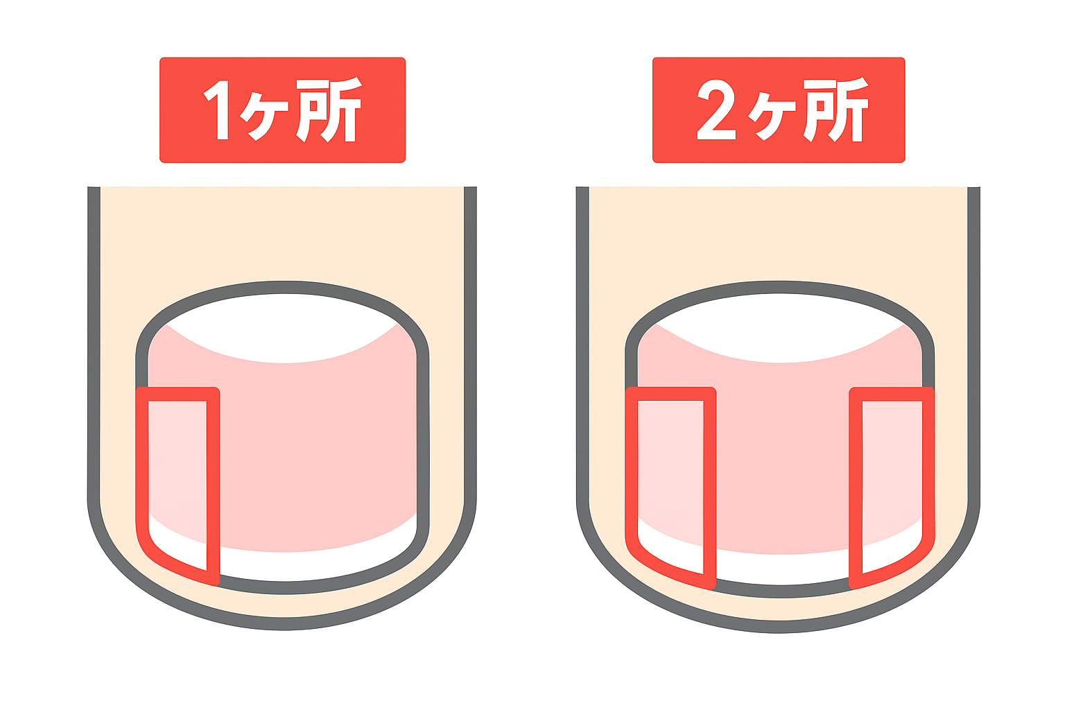 巻き爪の施術箇所