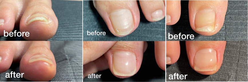 巻き爪のbefore-after